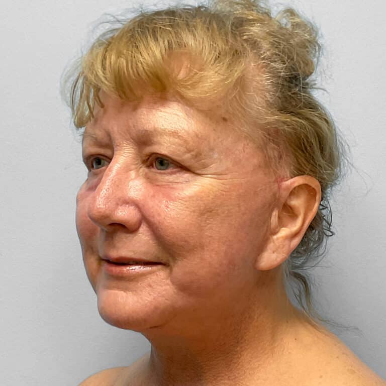 After Image: Facelift & TFX – Dr. Tucker - left-front-oblique