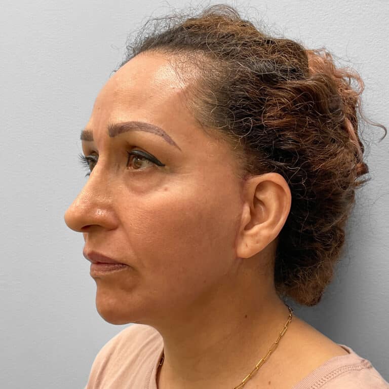 After Image: Facelift & Laser Resurfacing – Dr. Tucker - left-front-oblique