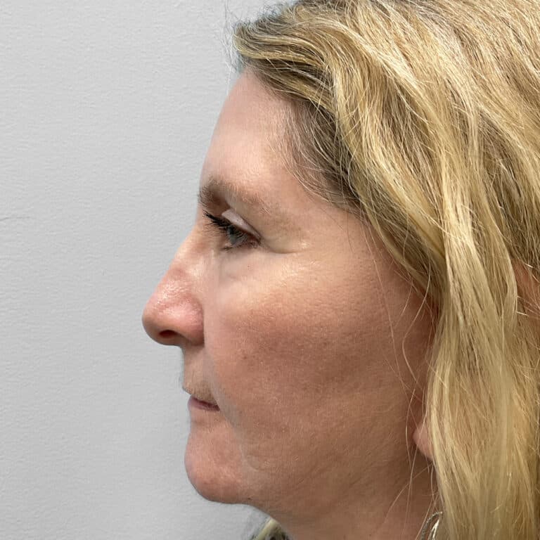 After Image: Facelift, Blepharoplasty, TFX – Dr. Tucker - left-side