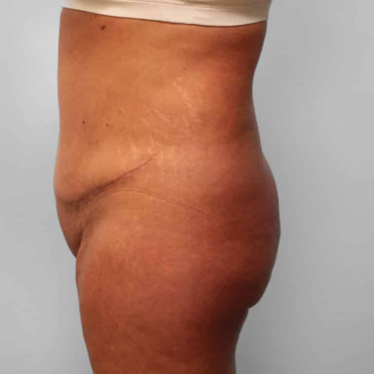 After Image: Tummy Tuck & Lipo – Dr. Tucker - left-side