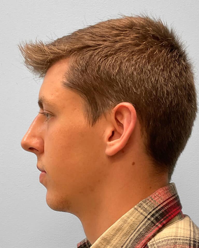 After Image: Rhinoplasty – Dr. Tucker - left-side