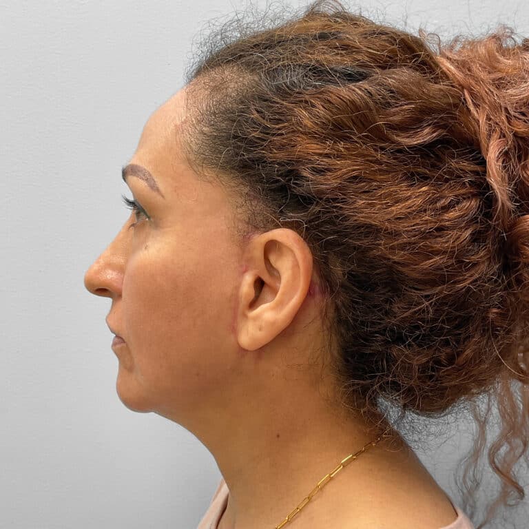 After Image: Facelift & Laser Resurfacing – Dr. Tucker - left-side