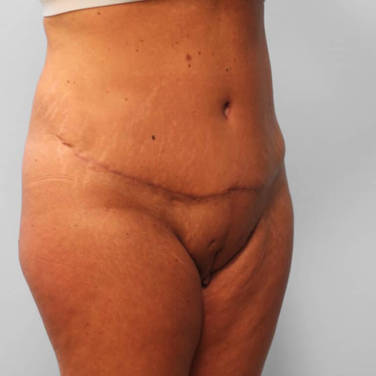 After Image: Tummy Tuck & Lipo – Dr. Tucker - right-front-oblique