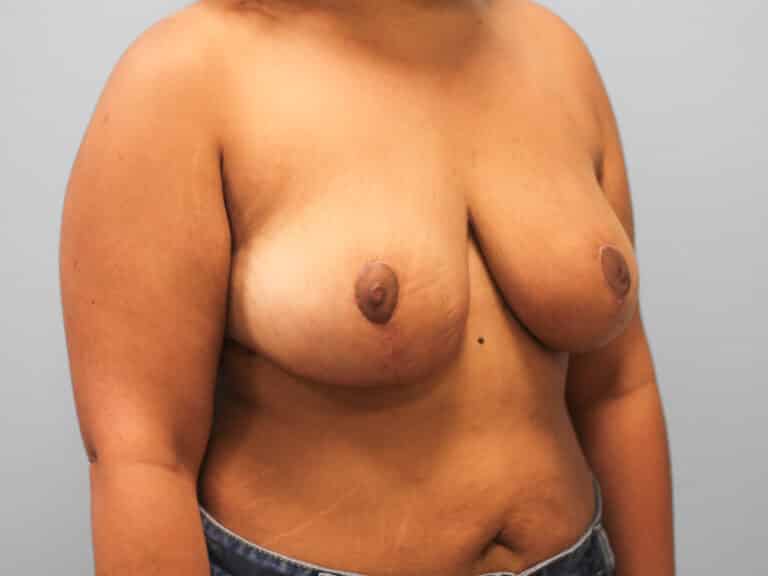 After Image: Breast Reduction – Dr. Tucker - right-front-oblique