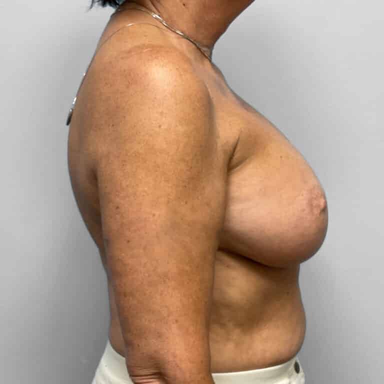 After Image: Breast Augmentation – Dr. Tucker - right-side