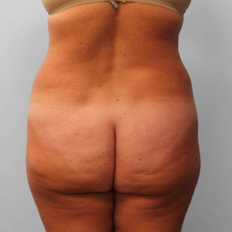 Before Image: Tummy Tuck & Lipo – Dr. Tucker - back