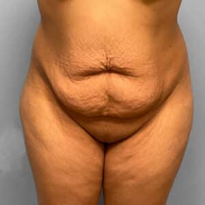 Before Image: Abdominoplasty & Lipo Dr. Tucker