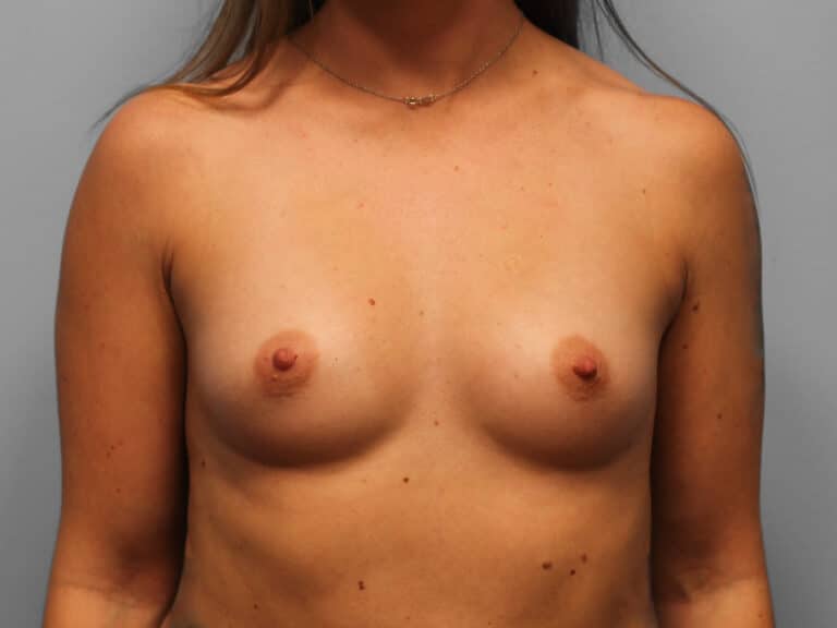 Before Image: Breast Augmentation – Dr. Tucker - front