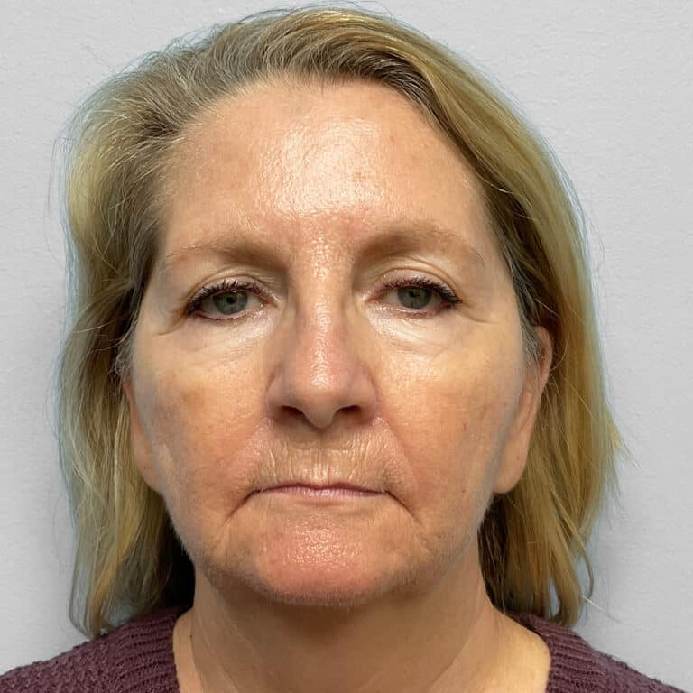 Before Image: Facelift, Blepharoplasty, TFX – Dr. Tucker - front