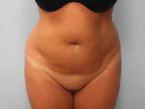 Before Image: Abdominoplasty & Lipo – Dr. Tucker