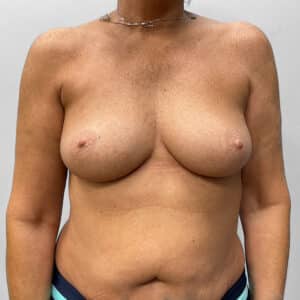 Before Image: Breast Augmentation – Dr. Tucker