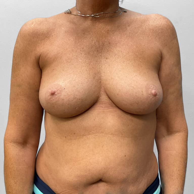 Before Image: Breast Augmentation – Dr. Tucker - front