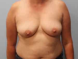 Before Image: Breast Augmentation – Dr. Tucker