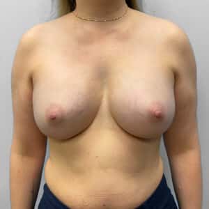 Before Image: Breast Augmentation – Dr. Tucker