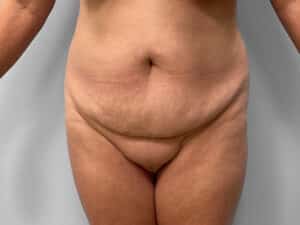 Before Image: Tummy Tuck & Lipo – Dr. Tucker