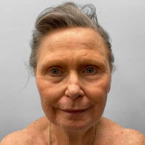 Before Image: Facelift – Dr. Tucker