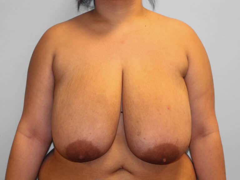 Before Image: Breast Reduction – Dr. Tucker - front