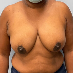 Before Image: Breast Augmentation – Dr. Tucker