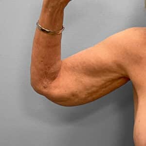 Before Image: Arm Lift – Dr. Tucker