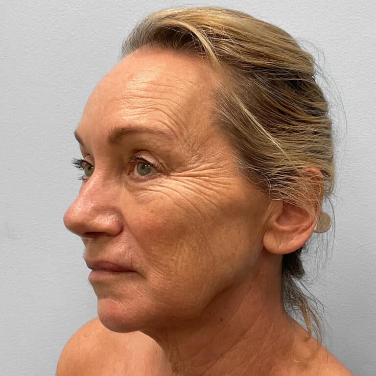 Before Image: Facelift & TFX – Dr. Tucker - left-front-oblique