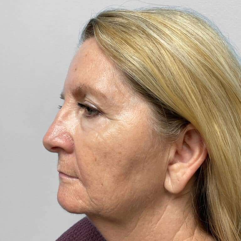 Before Image: Facelift, Blepharoplasty, TFX – Dr. Tucker - left-side