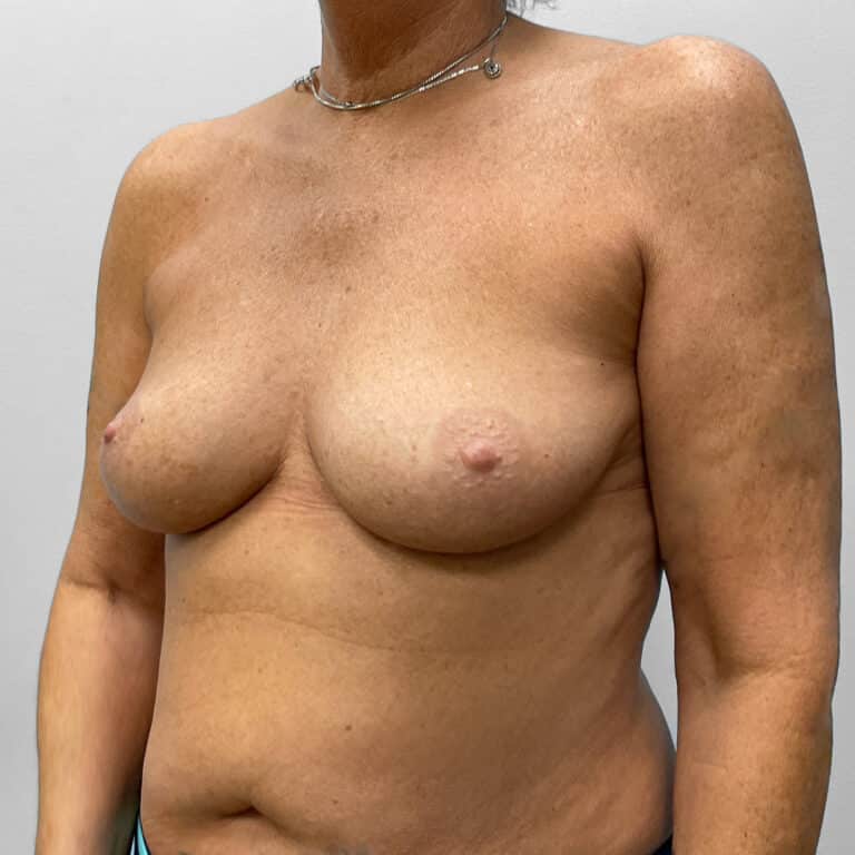 Before Image: Breast Augmentation – Dr. Tucker - left-front-oblique