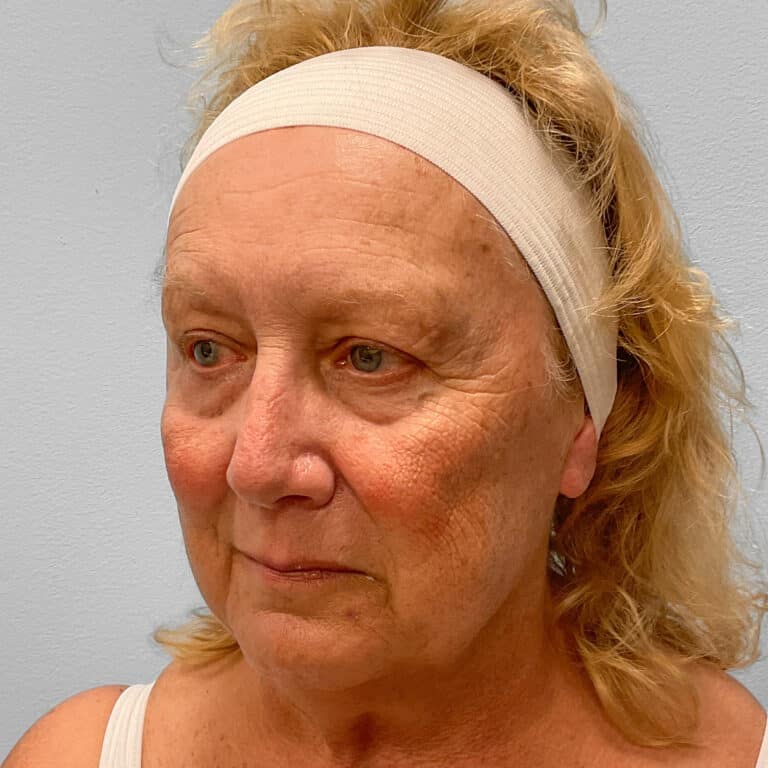 Before Image: Facelift & TFX – Dr. Tucker - left-front-oblique