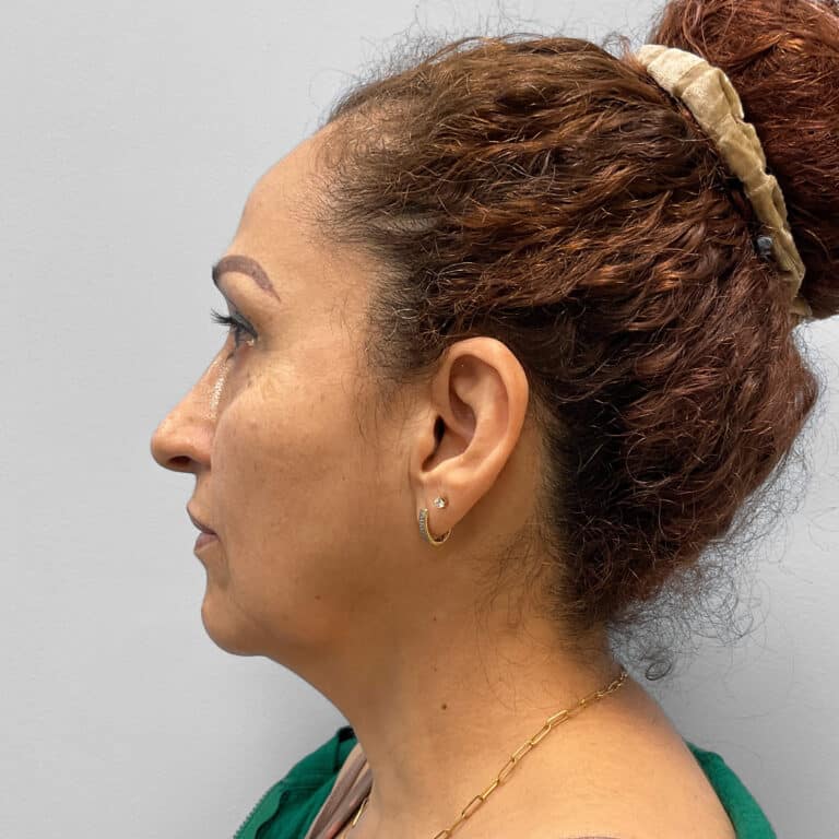 Before Image: Facelift & Laser Resurfacing – Dr. Tucker - left-side