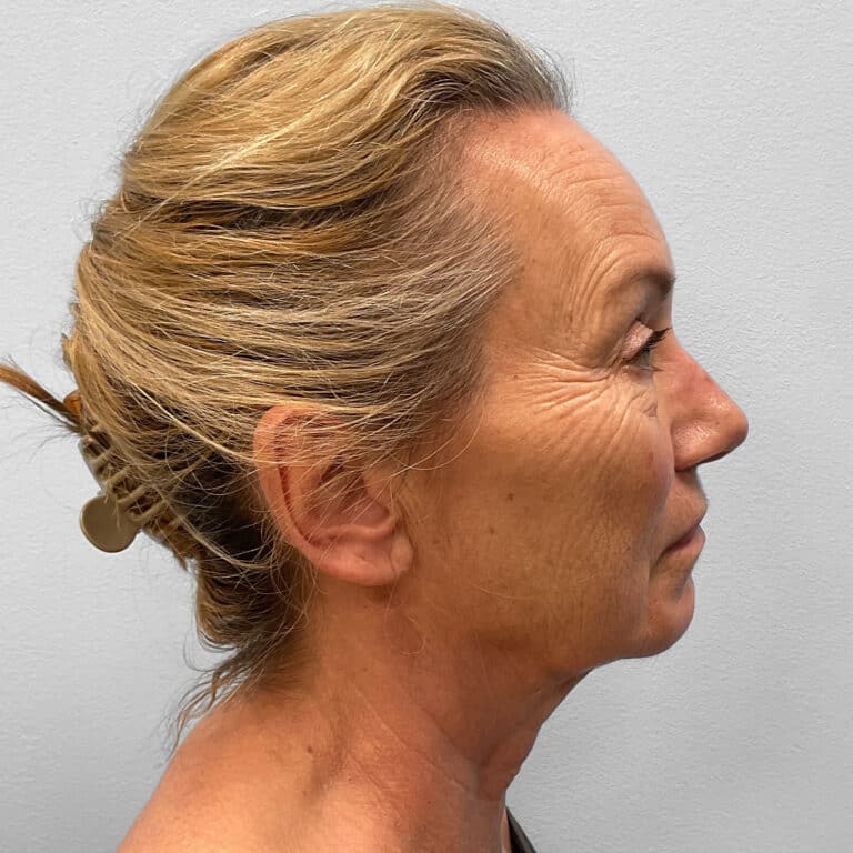 Before Image: Facelift & TFX – Dr. Tucker - right-side