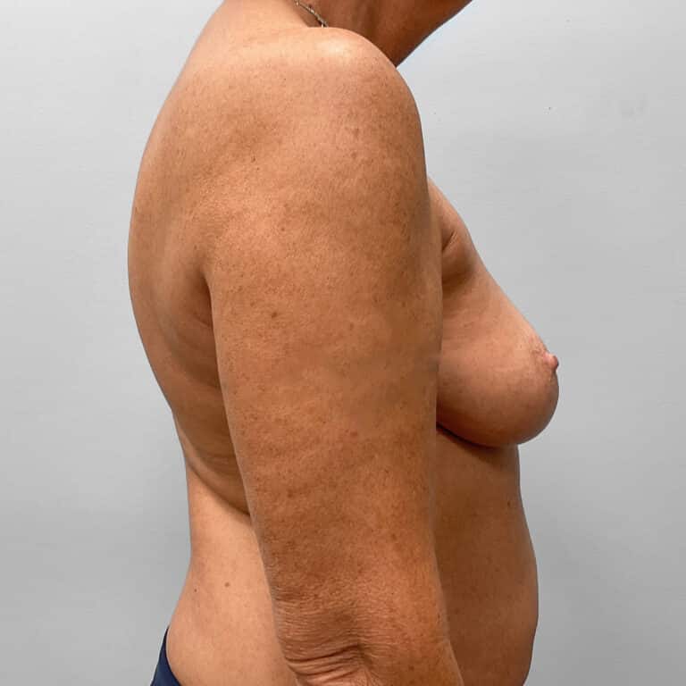 Before Image: Breast Augmentation – Dr. Tucker - right-side