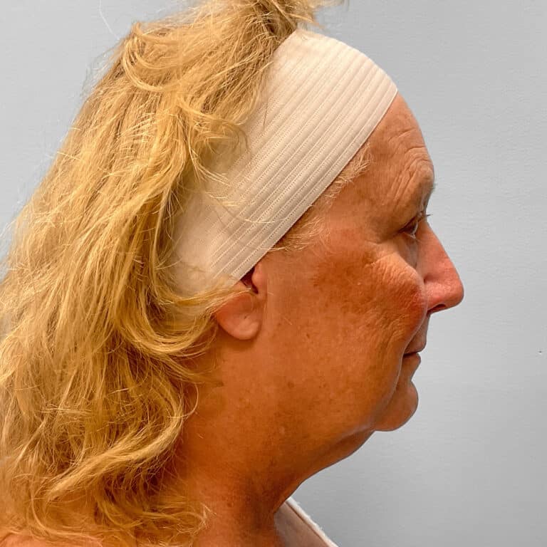 Before Image: Facelift & TFX – Dr. Tucker - right-side