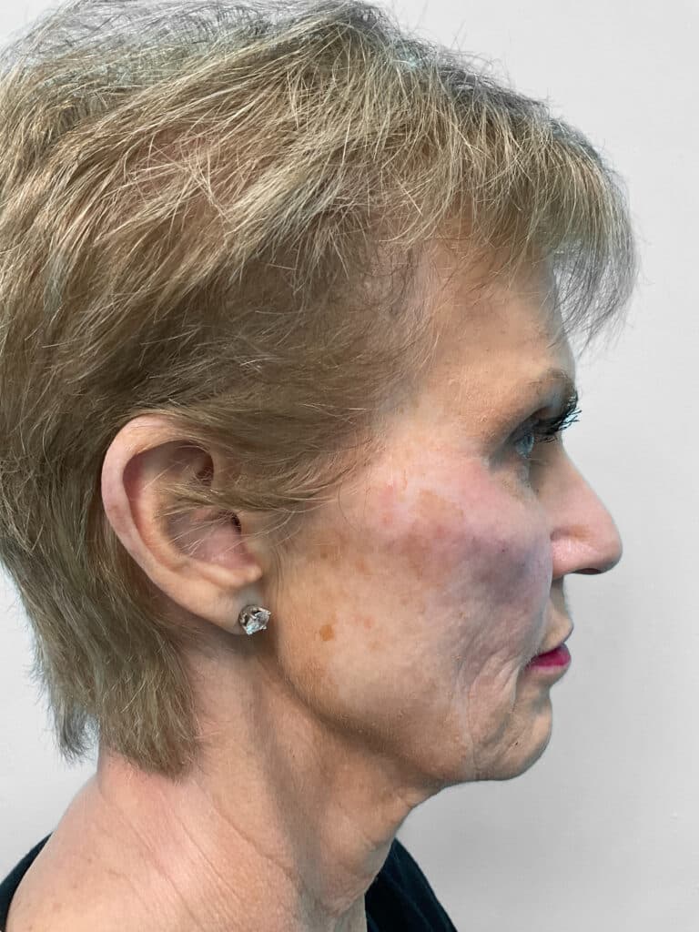 Before Image: Filler – Heather - right-side