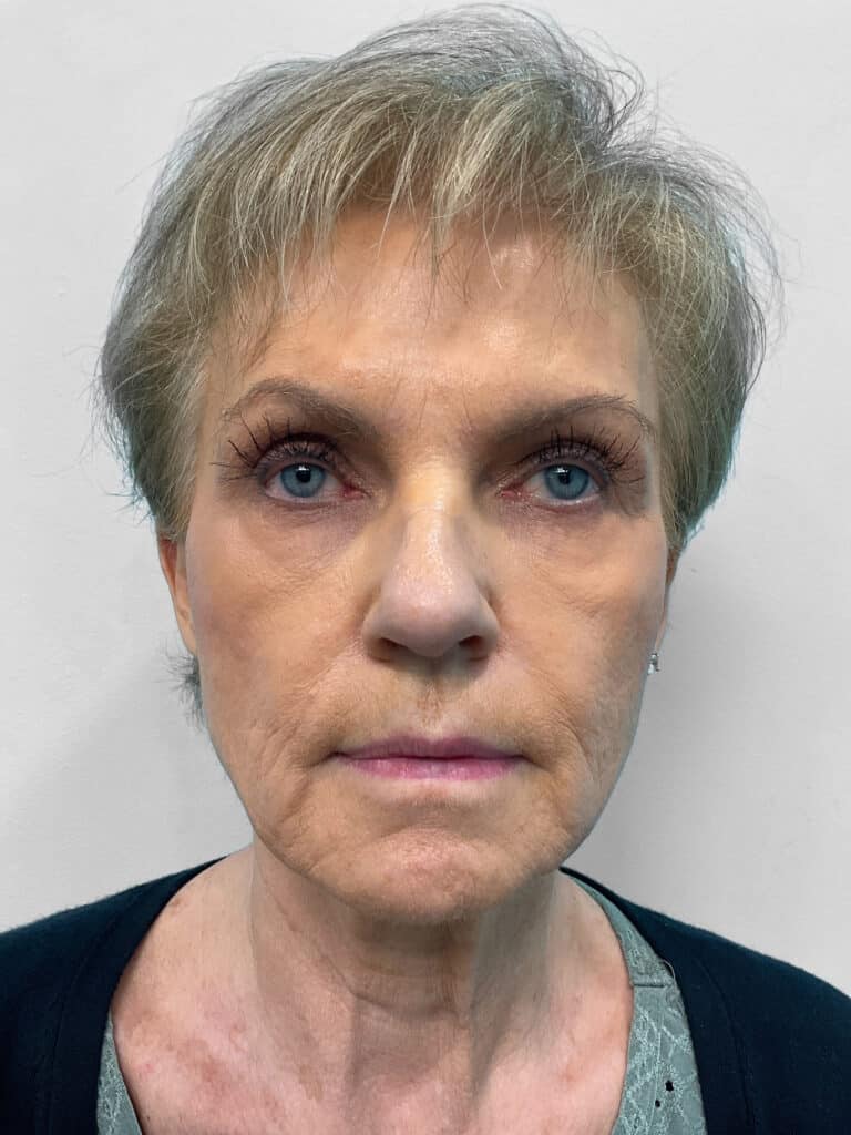 Before Image: Filler – Heather - front