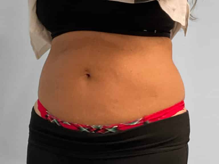 Before Image: Emsculpt Neo – Jessica - left-front-oblique