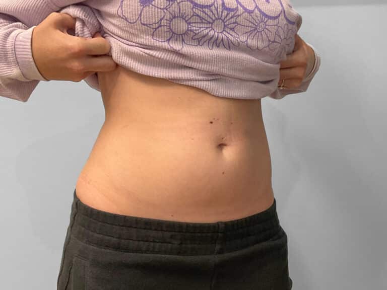 Before Image: Emsculpt Neo – Jessica - right-front-oblique