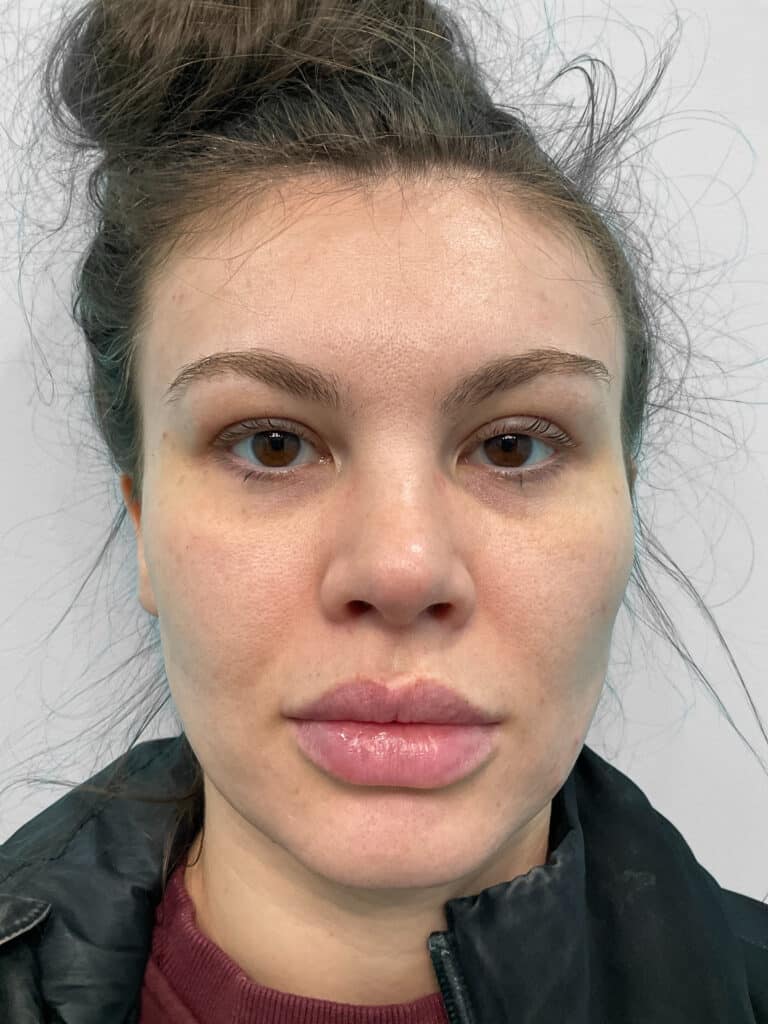 After Image: Juvederm – Heather - front