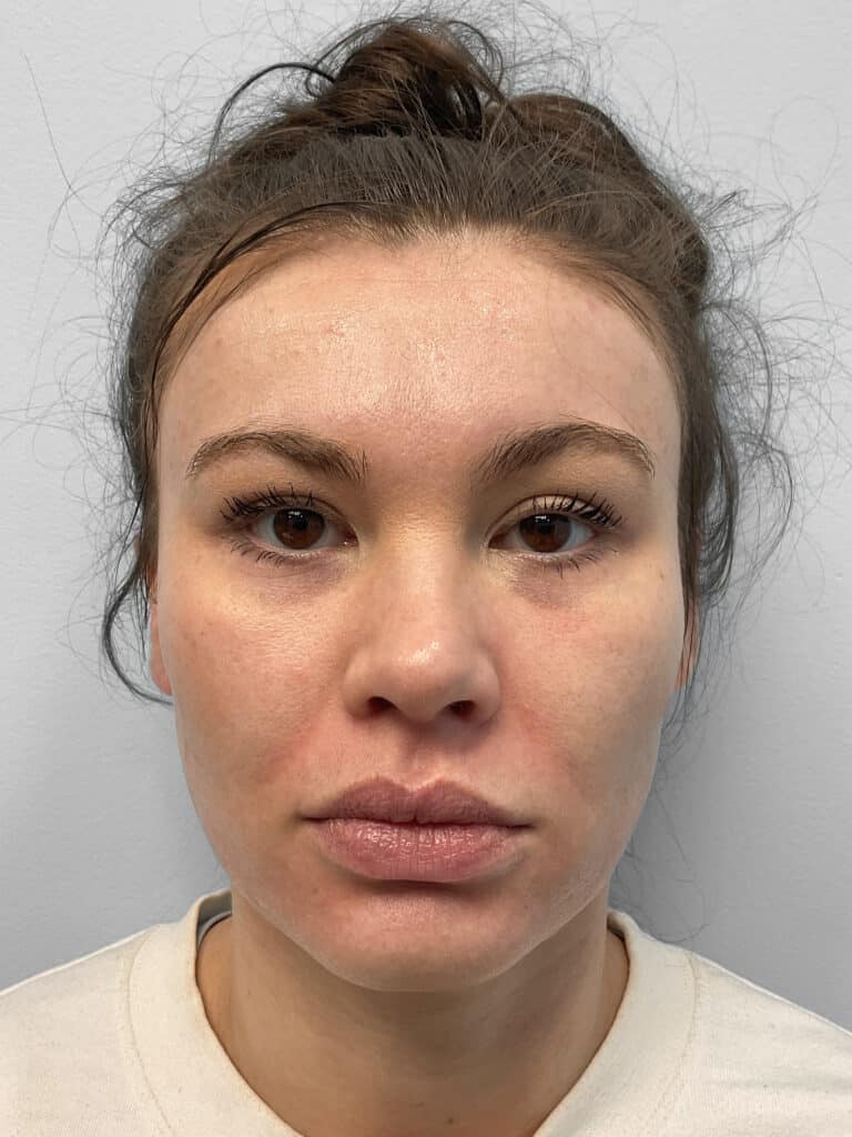 Before Image: Juvederm – Heather - front