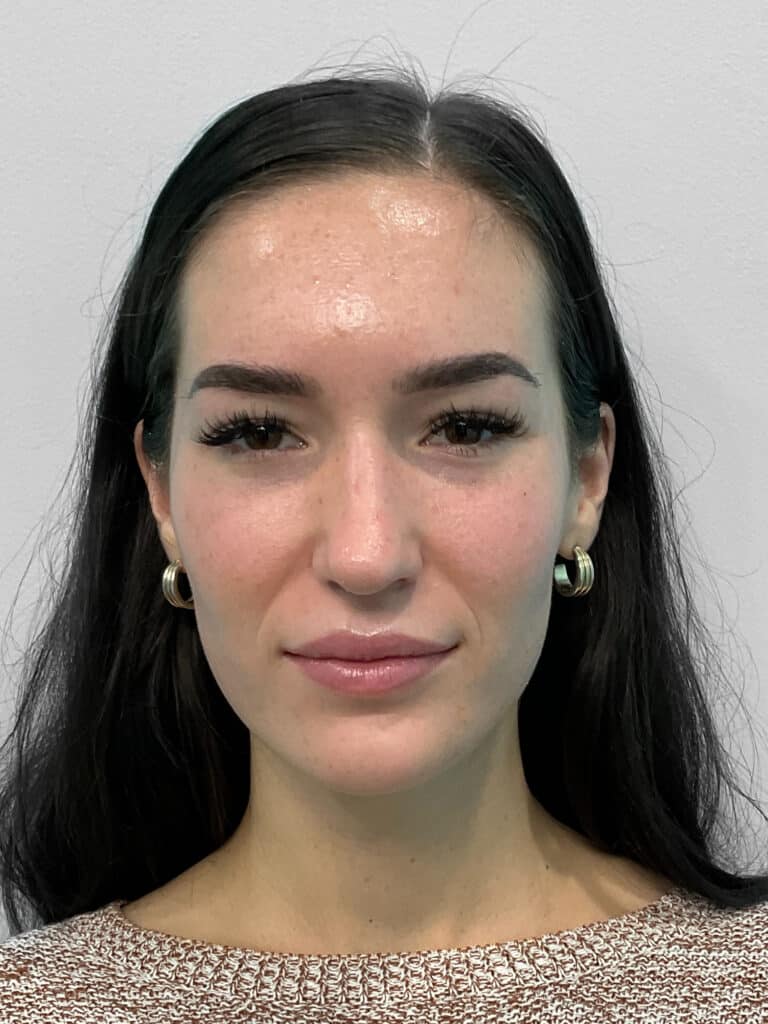 Before Image: Juvederm – Joy - front